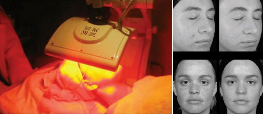 LED Light therapy beauty treatments Nelson at Elliott Cottage Skin & Beauty Therapy