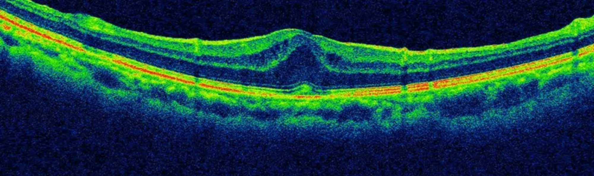 Oct Retinal Imaging Now At Cassidy Eyecare