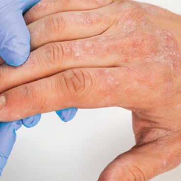 Do you have moderate-to-severe ATOPIC DERMATITIS that is impacting your quality of life?