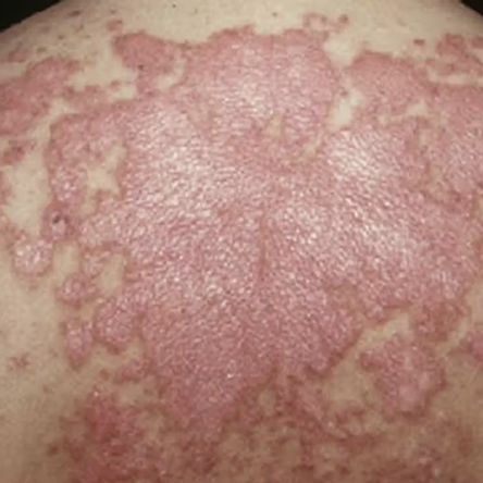 Cutaneous Lupus Erythematosus is a diverse group of autoimmune connective tissue disorders localised to the skin causing various types of skin rashes and lesions.
