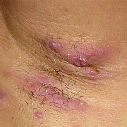 Atopic dermatitis, a form of eczema, is a chronic condition that causes the skin to become inflamed, irritated, and itchy. Although it is a common condition that usually begins in childhood, anyone can develop it.