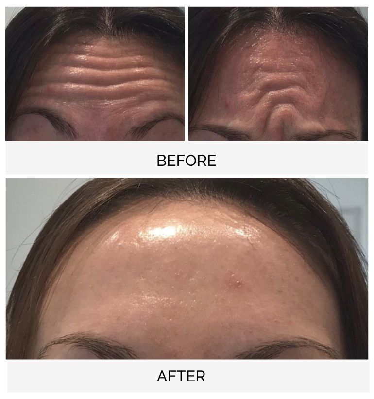botox injections on forehead