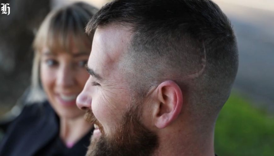 Lars' craniotomy scar is the only outward sign remaining, yet recovery from a TBI is hidden and ongoing. Photo: J Oxenham for NZ Herald.
