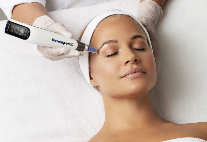 dermal needling microneedling richmond nelson