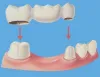 Dental Bridges