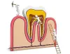 Root Canal Treatment
