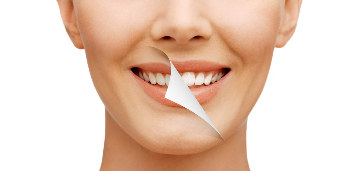 Teeth whitening at Richmond Dental Centre, Nelson New Zealand