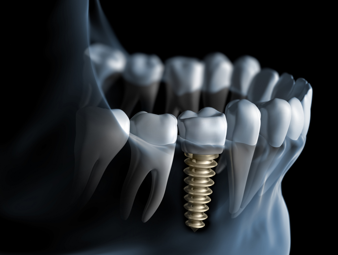 What are dental implants? Richmond Dentists - Richmond Dental Centre Nelson NZ